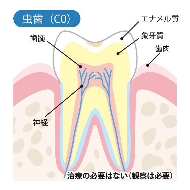 大田区中央（池上・大森）の歯医者、谷歯科クリニック、むし歯治療