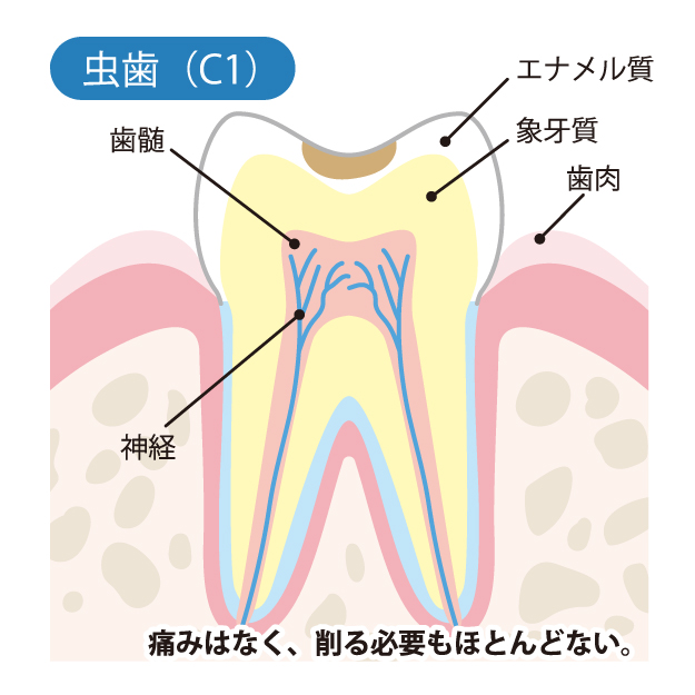 大田区中央（池上・大森）の歯医者、谷歯科クリニックで、むし歯治療