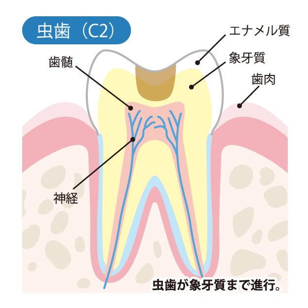 大田区中央（池上・大森）の歯医者、谷歯科クリニックで、むし歯治療