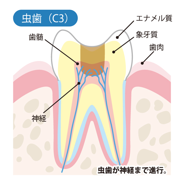 大田区中央（池上・大森）の歯医者、谷歯科クリニックで、むし歯治療