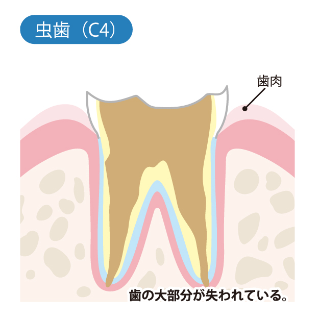 大田区中央（池上・大森）の歯医者、谷歯科クリニックで、むし歯治療