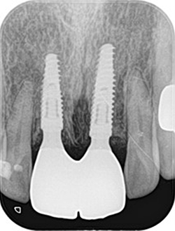 大田区中央（池上・大森）の歯医者,
谷歯科クリニックのインプラント症例