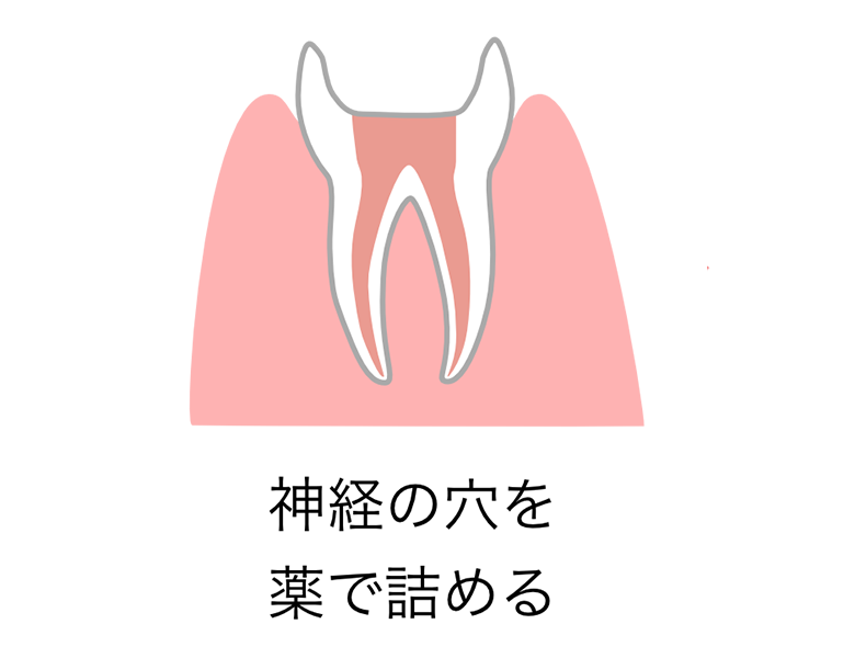 大田区中央（池上・大森）の歯医者、谷歯科クリニックで根管治療