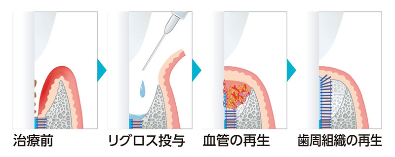 大田区中央（池上・大森）の歯医者、谷歯科クリニックの歯周病治療