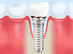 大田区中央（池上・大森）の歯医者、谷歯科クリニックのインプラント治療