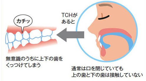 大田区中央（池上・大森）の歯医者、谷歯科クリニックで顎関節症対策