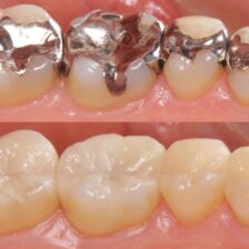 大田区中央（池上・大森）の歯医者: 谷歯科クリニックで銀歯を白くしたいときの選択肢についての解説