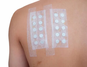 大田区中央（池上・大森）の歯医者: 谷歯科クリニックで歯科治療による金属アレルギーについての解説