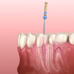 大田区中央（池上・大森）の歯医者: 谷歯科クリニックで歯の神経を抜いた後の根管治療失敗を防ぐ患者さん側のポイントを解説
