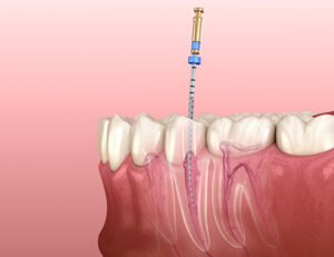 大田区中央（池上・大森）の歯医者: 谷歯科クリニックで歯の神経を抜いた後の根管治療失敗を防ぐ患者さん側のポイントを解説