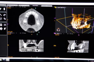 大田区中央（池上・大森）の歯医者: 谷歯科クリニックで歯科用CTとレントゲンの違いとは？それぞれの検査が必要なケースを解説