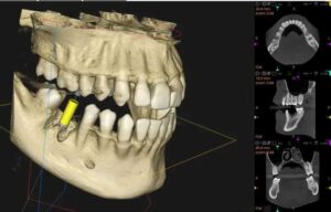 大田区中央（池上・大森）の歯医者: 谷歯科クリニックで歯科用CTとレントゲンの違いとは？それぞれの検査が必要なケースを解説