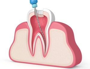 大田区中央（池上・大森）の歯医者: 谷歯科クリニックで歯の神経を抜いた後の根管治療失敗を防ぐ患者さん側のポイントを解説