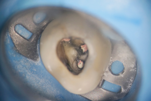 大田区中央（池上・大森）の歯医者: 谷歯科クリニックで歯の神経を抜いた後の根管治療失敗を防ぐ患者さん側のポイントを解説