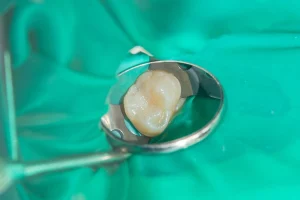 大田区中央（池上・大森）の歯医者: 谷歯科クリニックで歯の神経を抜いた後の根管治療失敗を防ぐ患者さん側のポイントを解説