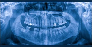 大田区中央（池上・大森）の歯医者: 谷歯科クリニックで歯科用CTとレントゲンの違いとは？それぞれの検査が必要なケースを解説