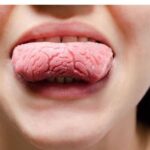 大田区中央（池上・大森）の歯医者: 谷歯科クリニックで舌がひび割れる「溝状舌」の症状と治療法についての解説