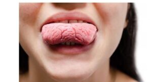 大田区中央（池上・大森）の歯医者: 谷歯科クリニックで舌がひび割れる「溝状舌」の症状と治療法についての解説