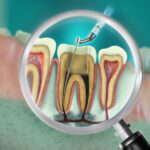 大田区中央（池上・大森）の歯医者: 谷歯科クリニックで根管治療中に転院するのはあり？注意点やメリット・デメリットを解説