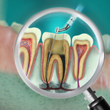 大田区中央（池上・大森）の歯医者: 谷歯科クリニックで根管治療中に転院するのはあり？注意点やメリット・デメリットを解説