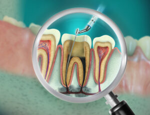 大田区中央（池上・大森）の歯医者: 谷歯科クリニックで根管治療中に転院するのはあり？注意点やメリット・デメリットを解説
